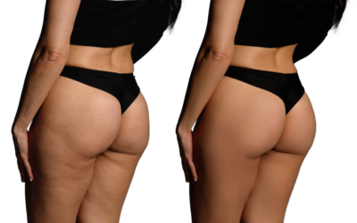 Cellulite Treatment