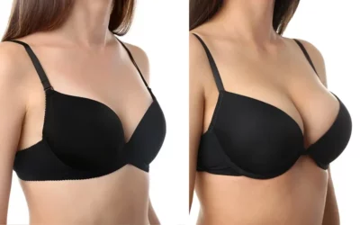 Breast Lift